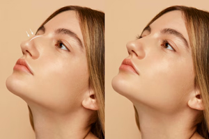 Silicone Rhinoplasty image